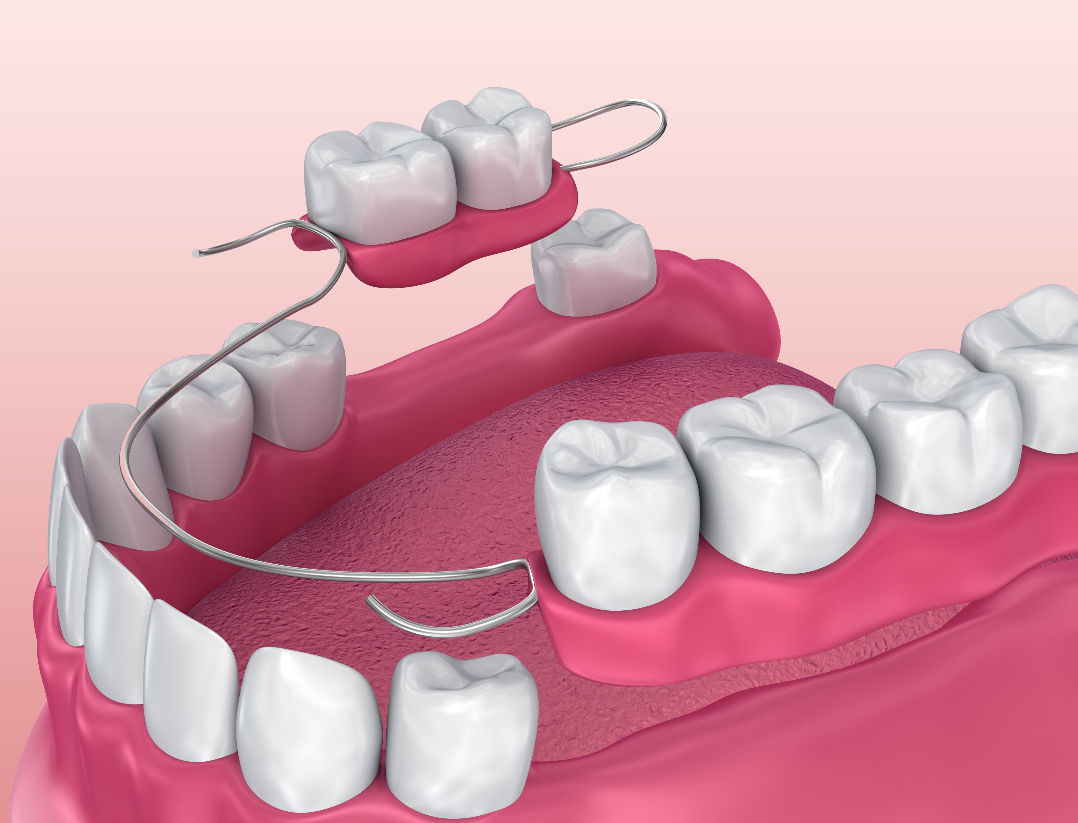 partial dentures